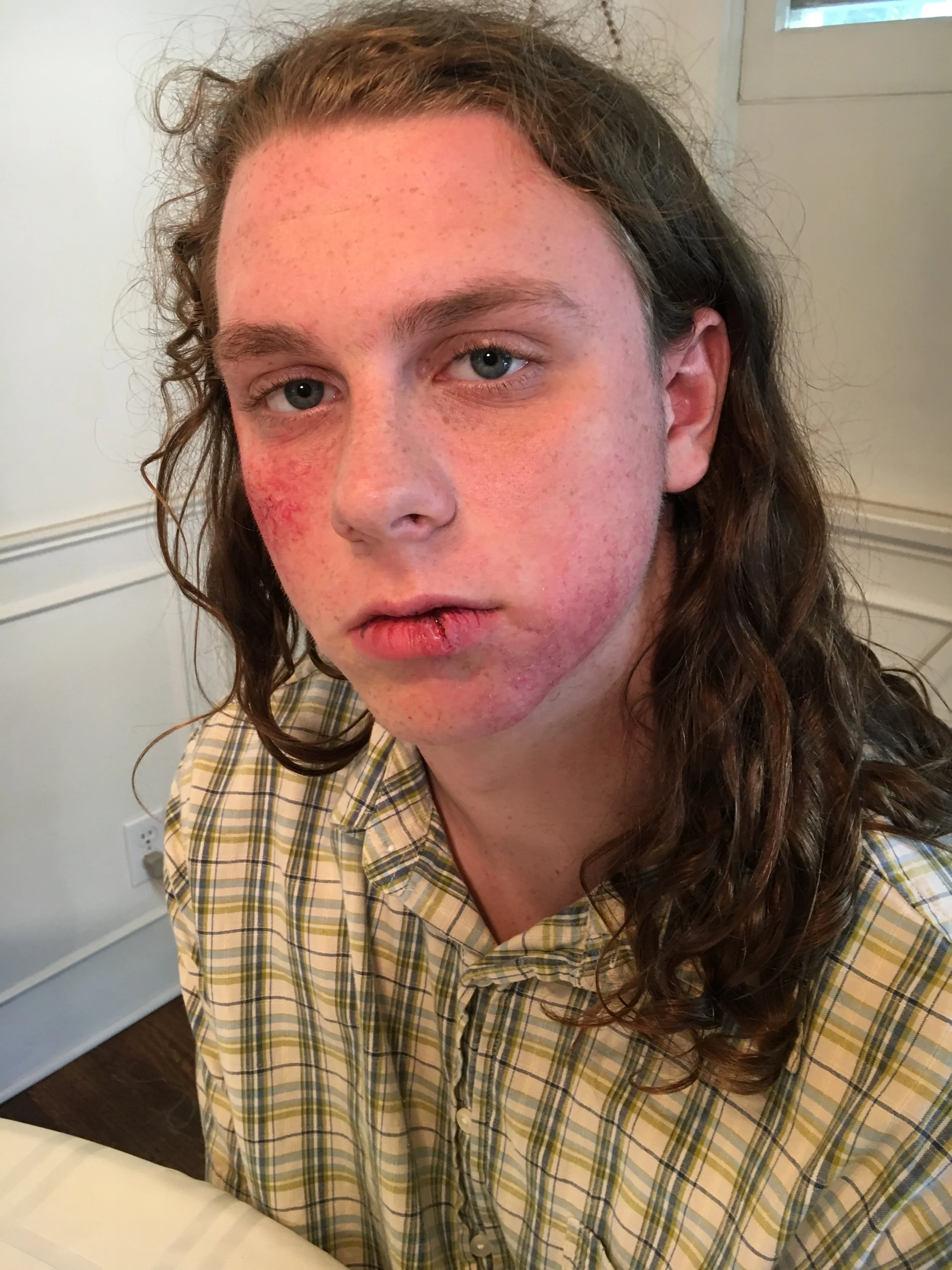 bruises/split lip